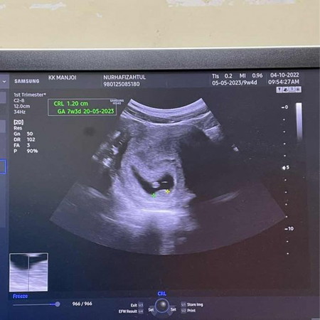 Scan baby 9 weeks