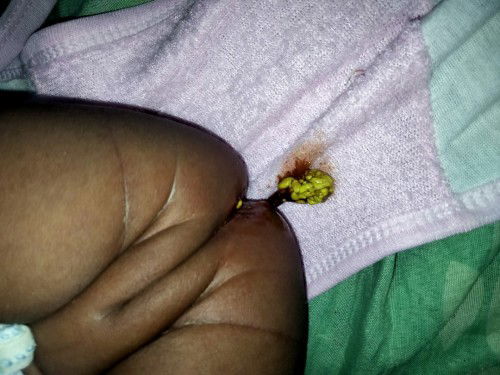 Bab bayi berlendir darah