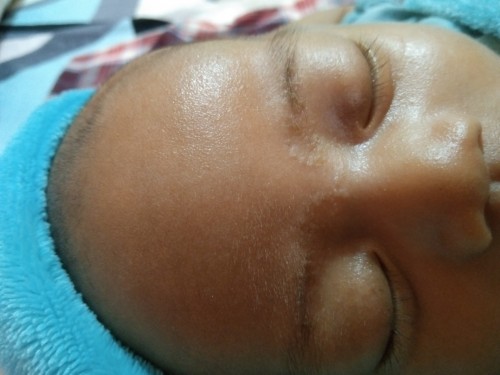Obat yg aman untuk kurap pada bayi usia 1 bln apa ya bun
