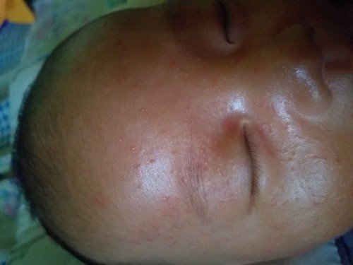 Muka bruntus merah