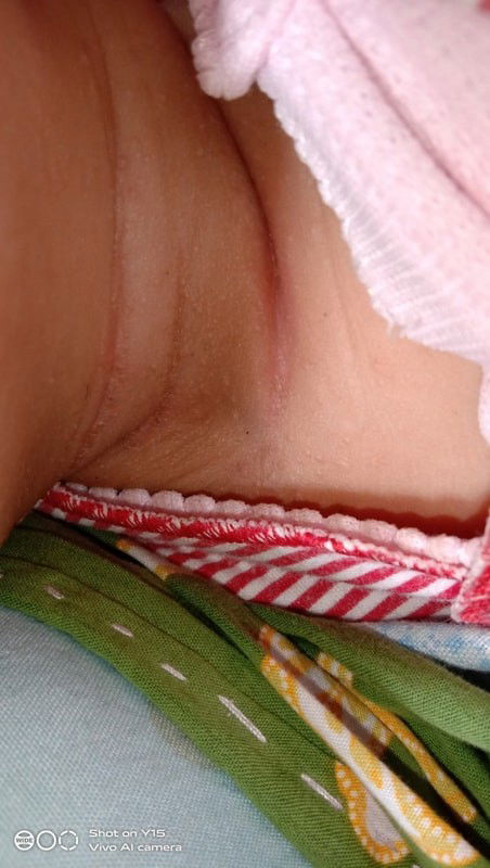 Leher bayi merah bintik²