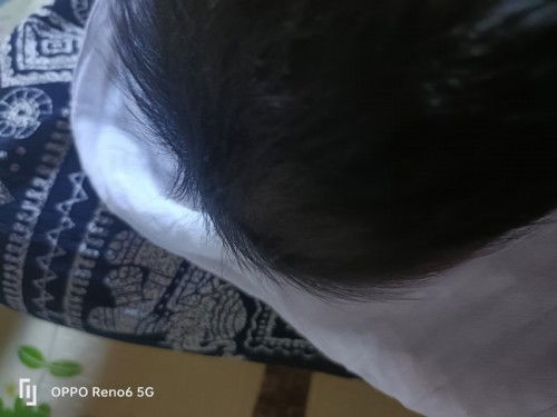 ศีรษะลูกปูดบวมหลังจากหมอทำคลอด