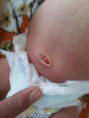 Bun,mgkin ada yg prnah ngalamin, bayiku 1 bulan 18 hari, pusarnya blm kering. Kira" diapakan ya bun?