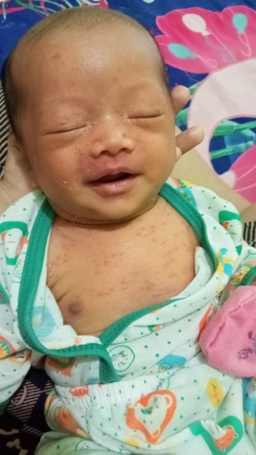 Bintik merah di badan bayi