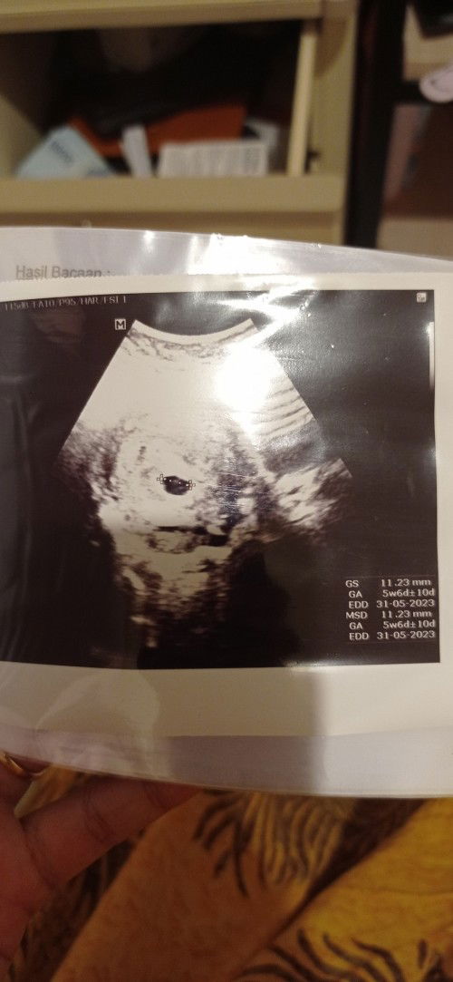 Posisi kantung janin