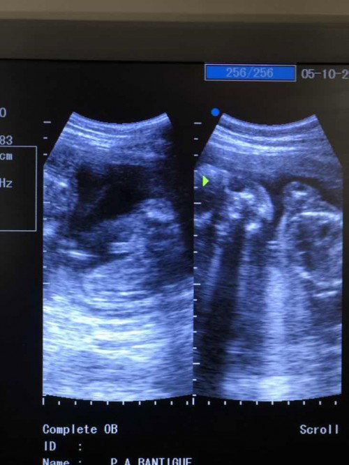 Boy or girl ?? First baby ko boy 🥹