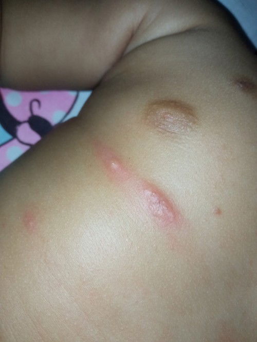 Bintik merah pada bayi 3 bulan