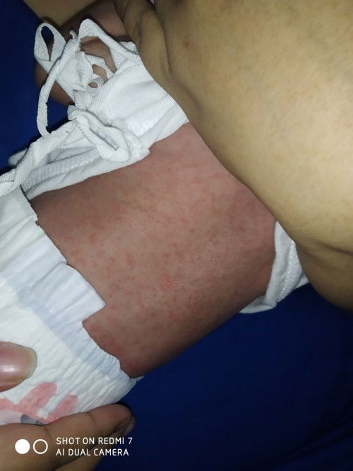 Rashes ni baby natatakot po kase kung anu to 16 days pa lang si baby .