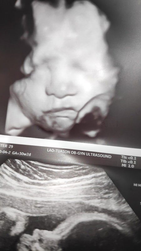 CAS Ultrasound - Complete Finally!