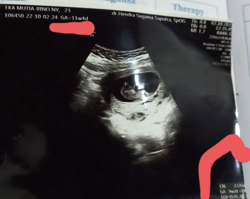 Bun mau nanya dong?knpa hasil usg perkiraan usia d keterangan atas sama bawah beda ya?