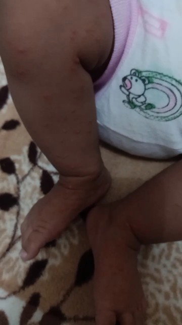 Kulit bayi merah2