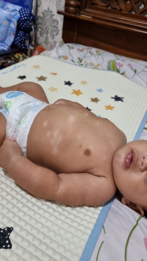 Kenapa ada bercak putih gitu di badan bayi aku ya bund. Ada yg sepengalaman? Solusinya dong bunda