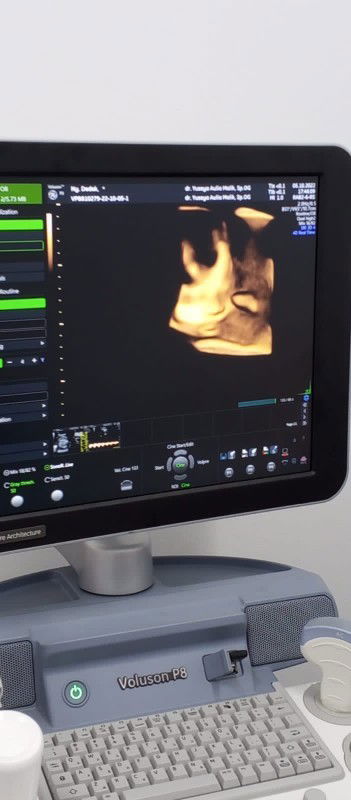 Air ketuban berlebihan