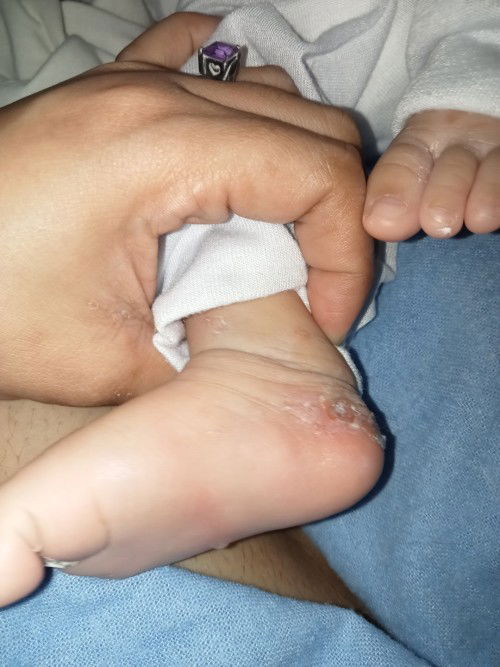 Ano poba pwede igamot sa baby ko nag tutubig tapos bigla naging sugat dumadami Po 😢 pahelp Po pls