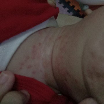 Leher merah bayi
