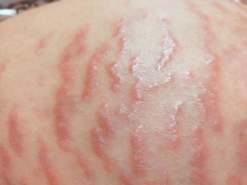 strech marks na parang may rashes