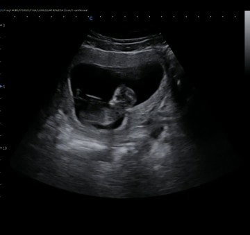 Usia kehamilan 14w4d
