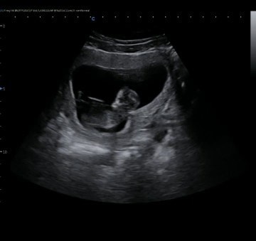 Usia kehamilan 14w4d