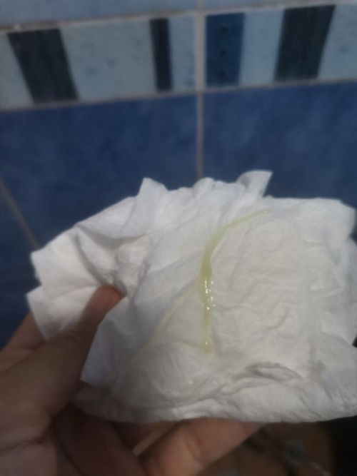 ตกขาวสีเขียวแบบนี้อันตรายไหมค่ะไม่คันไม่มีกลิ่น มีวิธี​รักษายังงัยค่ะ 
19wรูปไม่สุภาพ​ขออภัยค่ะ