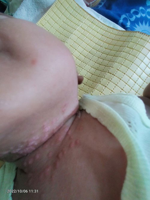 Minta solusinya bunda,anakku umur 3bulan lehernya merah2,dan bentol besar2,tidak seperti biang kerin