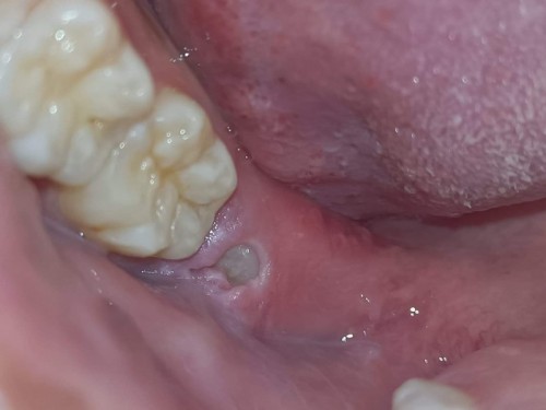 ท้องผ่าฟันคุดได้ไหม