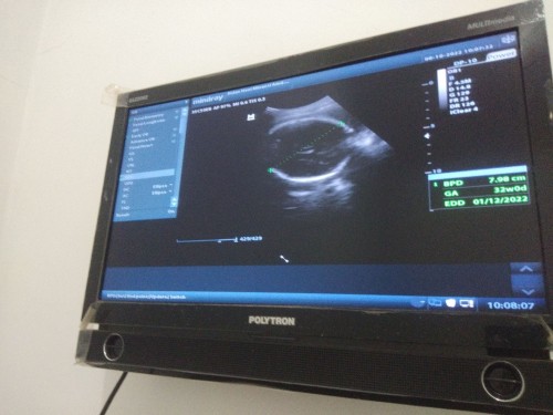 Baca hasil usg 2D