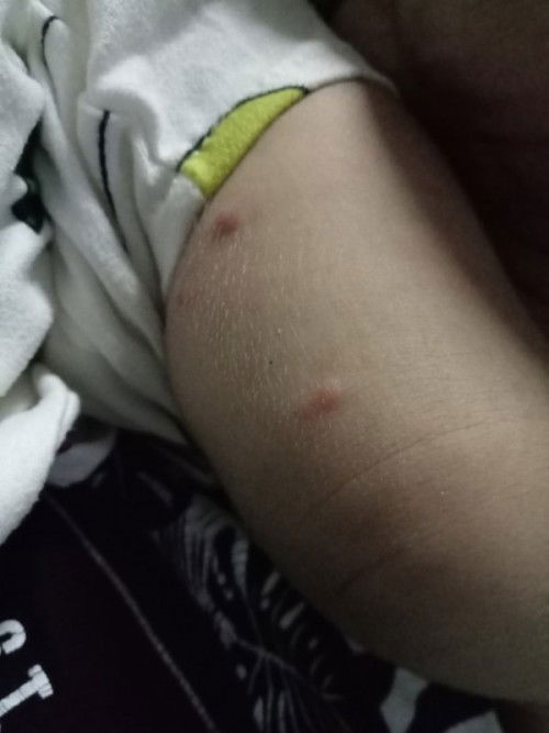 Mga mamsh ano pwede Gawin sa butlig na may tubig tapos dumadami ..