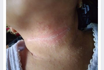 Biang keringat di leher