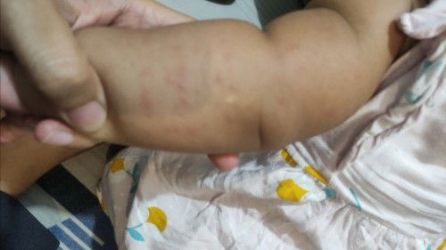 Bintik merah di tangan