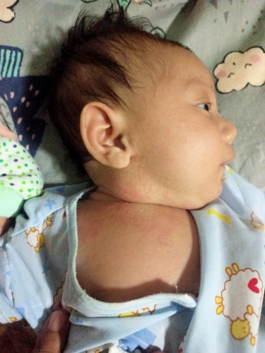 สอบถามหน่อยค่ะ น้องเป็นผื่นแบบนี้ใช้อะไรทาคะน้องเป็นเยอะมากใต้คอ(น้องเป็นผื่นอะไรค่ะ)