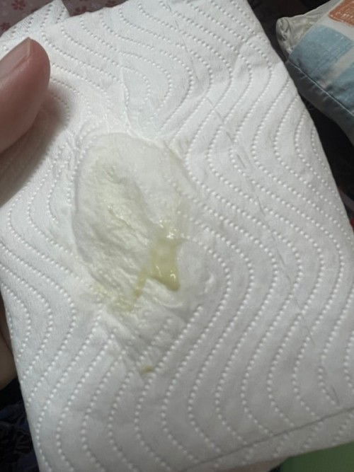 ตกขาวแบบนี้ อันตรายไหมค่ะ ขออภัยถ้าภาพมันน่าเกลียดนะคะ