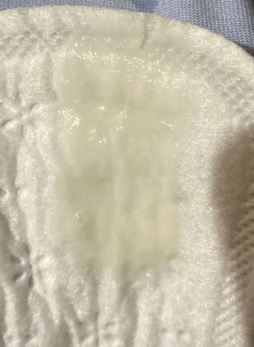 Ano po kayang discharge toh?