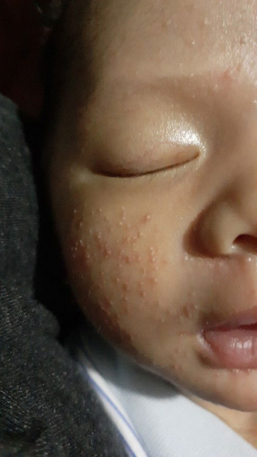 Kulit wajah beruntus putih