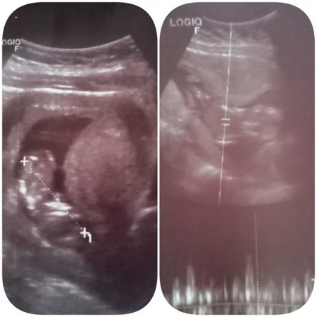 อยากถามแม่ๆว่าแตกต่างกันมั้ยคะรูปที่1ตอน12วีค3วันรูปที่2ตอน15วีค4วัน