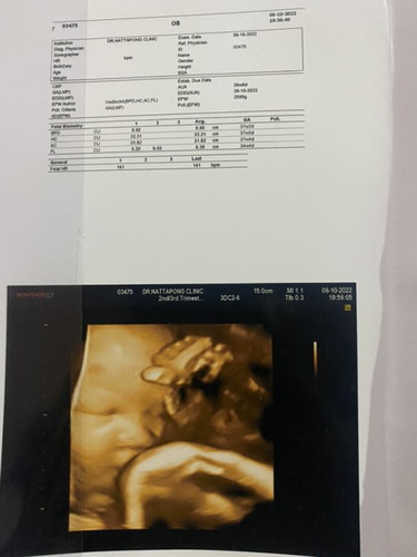 34 week กับน้ำหนัก 2,599 คับผม
อีกไม่กี่อาทิตย์ก็เจอกันละคับ คุณหมอบอกน้ำหนักดีคับ