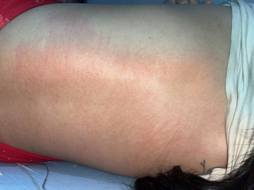 Munculnya gatal dibadan