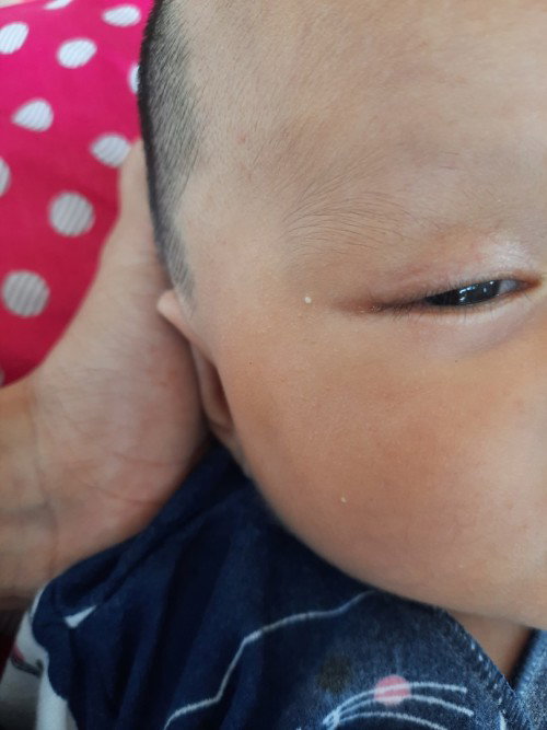 bintik putih di muka