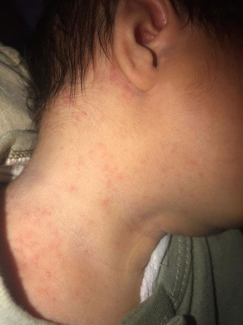 Bunda ini biang keringat apa bukan ya? Bayi saya baru 12 hari, muncul bintik2 merah begini apa ini.