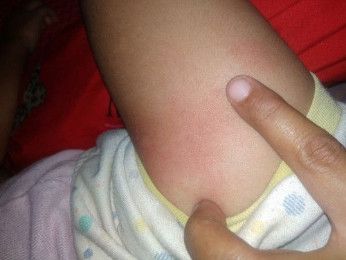 Mau tanyak dong bunda..p y obat biduran PD balita