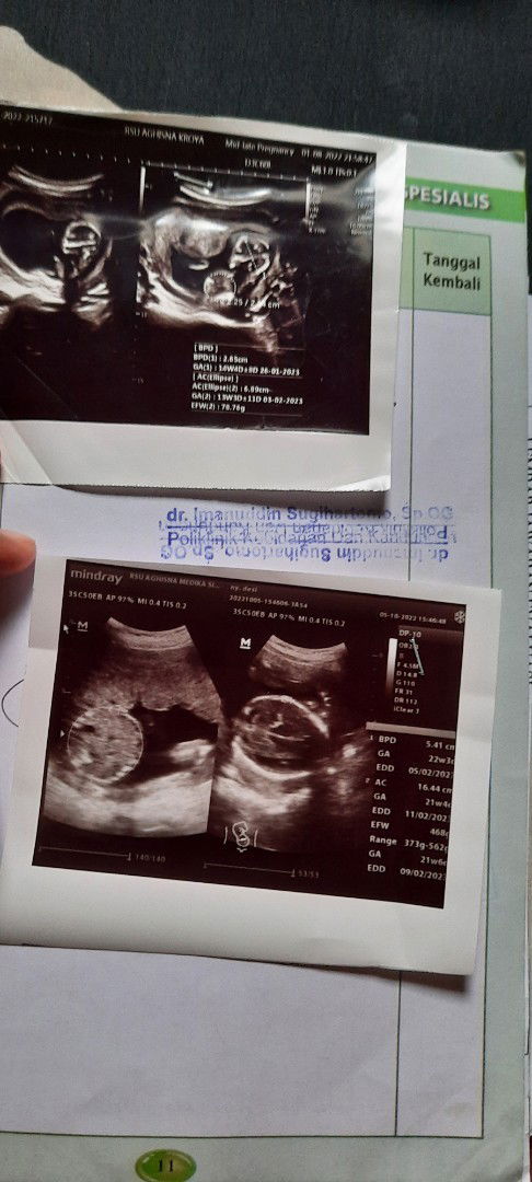 haloo bund tentang USG