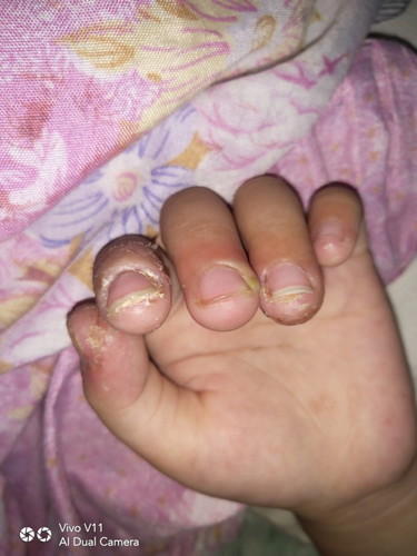 Sugat sa kamay ng aking 2 years old anu pwede ipahid o inumin
