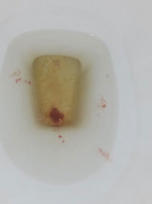 Blood sa wiwi Due on Oct 9