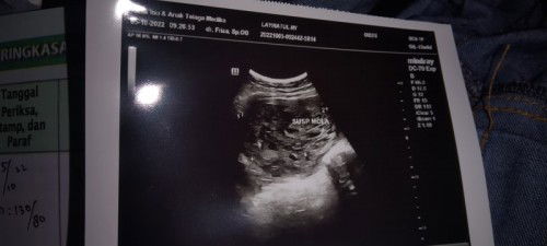 Flek di trimester pertama ternyata hamil anggur (yg aku AlAmin)