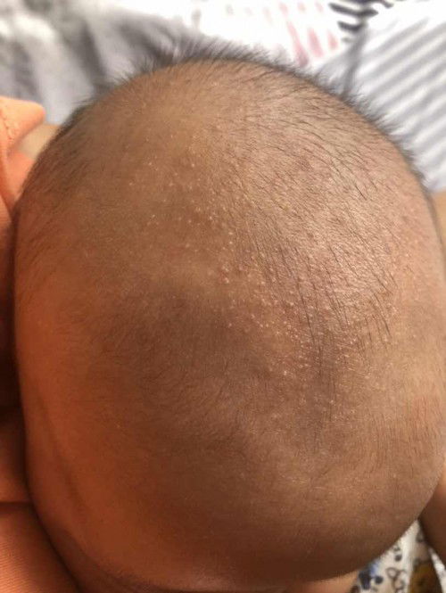 bintik bintik dikepala bayi