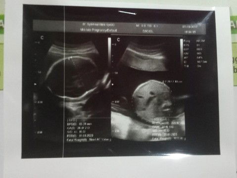 Hasil usg di usia kehamilan 27 week 2day