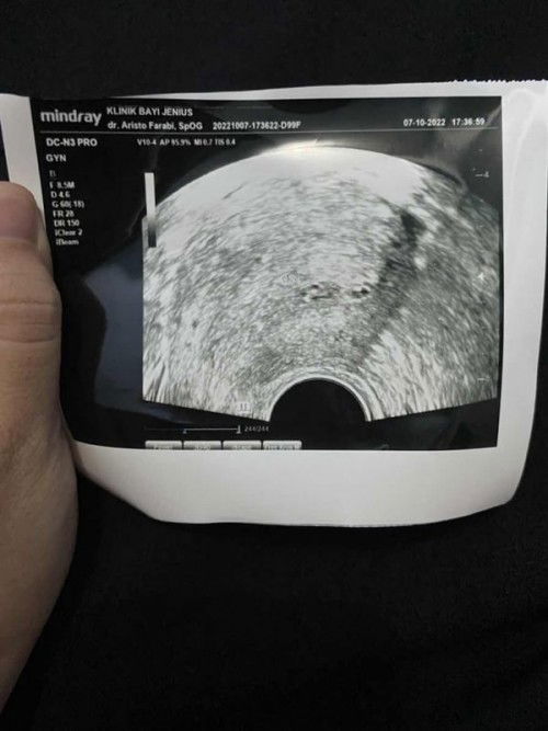 Penebalan dinding rahim