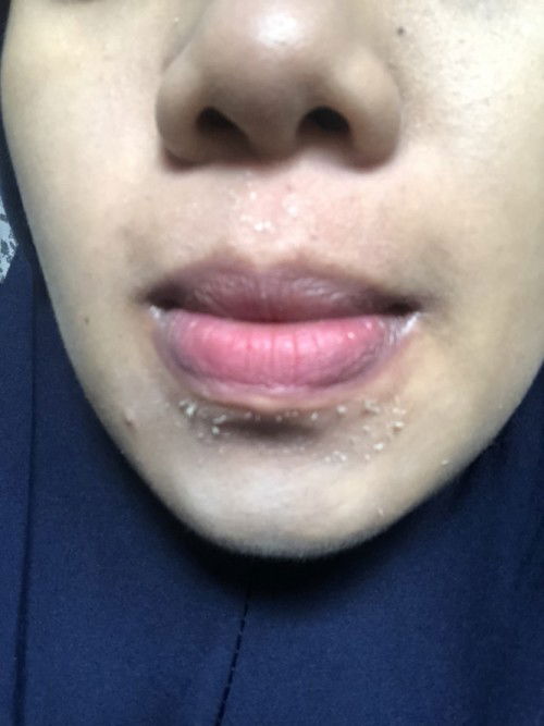 Kulit wajah kering mengelupas