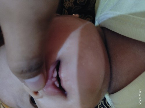 Apa ini Lip Tie??