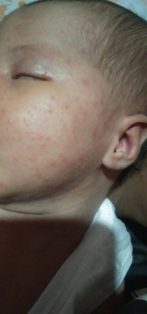 Butlig sa mukha ni baby