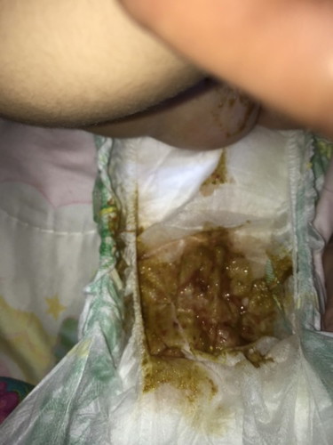 may dugo yung poop ni baby